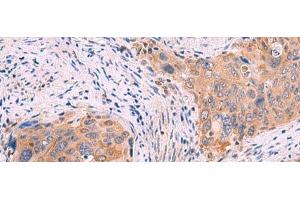 Immunohistochemistry of paraffin-embedded Human cervical cancer tissue using GSPT2 Polyclonal Antibody at dilution of 1:50(x200) (GSPT2 anticorps)