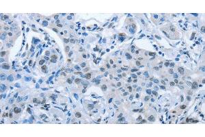 Immunohistochemistry of paraffin-embedded Human lung cancer tissue using ARHGEF2 Polyclonal Antibody at dilution 1:30