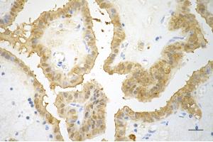 Immunohistochemistry was performed on paraffin-embedded human papillary thyroid carcinoma using galectin 3 antibody (ABIN7798688), 1:200). (Recombinant Galectin 3 anticorps)