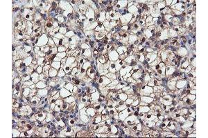 Immunohistochemical staining of paraffin-embedded Carcinoma of Human kidney tissue using anti-DPP9 mouse monoclonal antibody. (DPP9 anticorps)