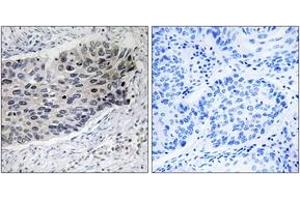 Immunohistochemistry analysis of paraffin-embedded human lung carcinoma tissue, using PC Antibody. (PC (AA 357-406) anticorps)
