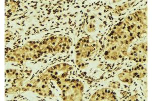 ABIN6276603 at 1/100 staining Human breast cancer tissue by IHC-P.
