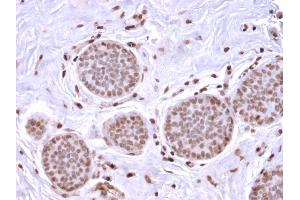 Formalin-fixed, paraffin-embedded human Breast Carcinoma stained with Mammaglobin Recombinant Rabbit Monoclonal Antibody (MGB1/2682R). (Recombinant Mammaglobin A anticorps)
