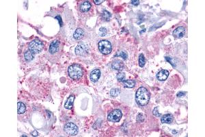 Anti-F2RL1 / PAR2 antibody IHC of human Breast, Carcinoma.