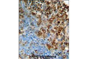ITPA Antibody immunohistochemistry analysis in formalin fixed and paraffin embedded human lung carcinoma followed by peroxidase conjugation of the secondary antibody and DAB staining. (ITPA anticorps  (N-Term))