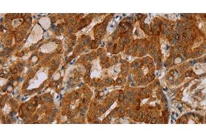 Immunohistochemistry of paraffin-embedded Human thyroid cancer tissue using MTUS1 Polyclonal Antibody at dilution 1:40 (MTUS1 anticorps)