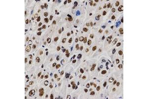 Immunohistochemistry of paraffin-embedded human liver cancer using PELP1 antibody (ABIN6292223) at dilution of 1:200 (40x lens). (PELP1 anticorps)