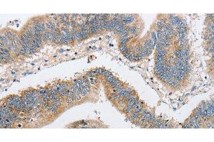 Immunohistochemistry of paraffin-embedded Human colon cancer using ARHGEF9 Polyclonal Antibody at dilution of 1:50 (Arhgef9 anticorps)