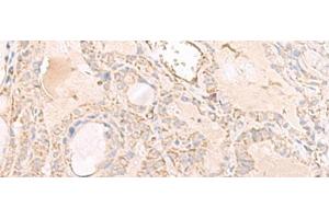 Immunohistochemistry of paraffin-embedded Human thyroid cancer tissue using IGHA1 Polyclonal Antibody at dilution of 1:65(x200) (IGHA1 anticorps)