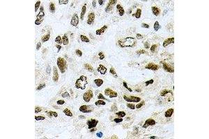 Immunohistochemical analysis of SAP145 staining in human lung cancer formalin fixed paraffin embedded tissue section. (SF3B2 anticorps)