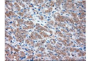 Immunohistochemical staining of paraffin-embedded Carcinoma of liver tissue using anti-SIGLEC9mouse monoclonal antibody. (SIGLEC9 anticorps)