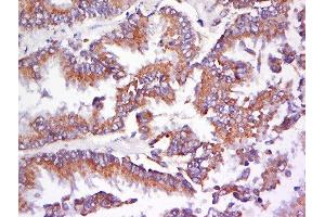 Formalin-fixed and paraffin embedded human lung carcinoma labeled with Anti-AMPK beta 1 Polyclonal Antibody, Unconjugated  at 1:200 followed by conjugation to the secondary antibody and DAB staining.