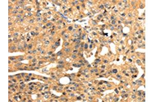 The image on the left is immunohistochemistry of paraffin-embedded Human breast cancer tissue using ABIN7131050(SH3KBP1 Antibody) at dilution 1/45, on the right is treated with fusion protein. (SH3KBP1 anticorps)