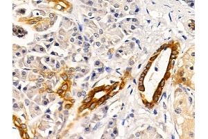 ABIN6265957 and ABIN6269022 at 1/100 staining Human pancreatic cancer and adjacent nomal tissues by IHC-P.