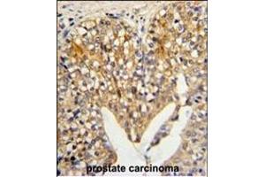Formalin-fixed and paraffin-embedded human prostate carcinoma reacted with LUM Antibody (N-term), which was peroxidase-conjugated to the secondary antibody, followed by DAB staining.