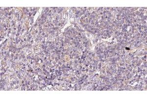 ABIN6273170 at 1/100 staining Human lymph cancer tissue by IHC-P. (STBD1 anticorps  (N-Term))