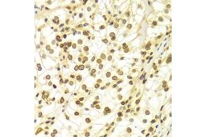 Immunohistochemistry of paraffin-embedded Human kidney cancer using Lamin A/C antibody.