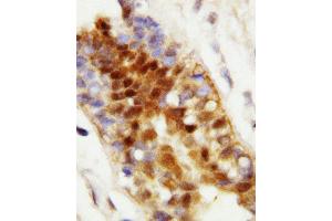 Anti-Hsc70 antibody, IHC(P) IHC(P): Human Mammary Cancer Tissue