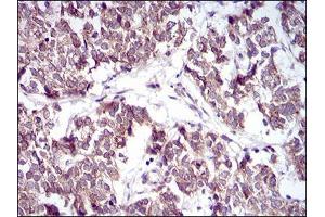 Immunohistochemical analysis of paraffin-embedded bladder cancer tissues using PTPN1 mouse mAb with DAB staining.