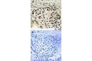Immunohistochemical staining of human breast carcinoma tissue by OXSR1 (phospho T185) polyclonal antibody  without blocking peptide (A) or preincubated with blocking peptide (B) under 1:50-1:100 dilution.