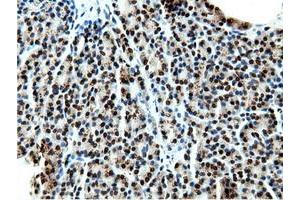 Immunohistochemical staining of paraffin-embedded Carcinoma of Human kidney tissue using anti-NT5DC1 mouse monoclonal antibody. (NT5DC1 anticorps)