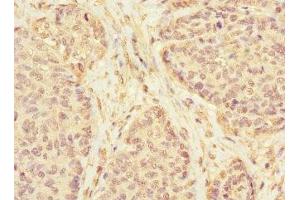 Immunohistochemistry of paraffin-embedded human ovarian cancer using ABIN7157271 at dilution of 1:100 (KLHL13 anticorps  (AA 1-260))