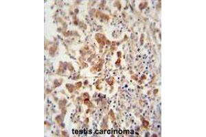TEX13B antibody (C-term) immunohistochemistry analysis in formalin fixed and paraffin embedded human testis carcinoma followed by peroxidase conjugation of the secondary antibody and DAB staining. (TEX13B anticorps  (C-Term))