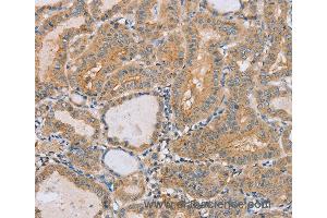 Immunohistochemistry of Human breast cancer using PTPN4 Polyclonal Antibody at dilution of 1:40 (PTPN4 anticorps)