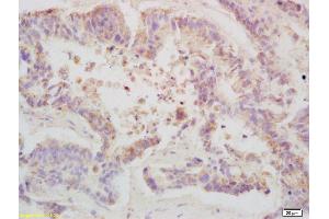 Formalin-fixed and paraffin embedded human colon carcinoma labeled with Anti-Phospho-TBK1/NAK (Ser172) Polyclonal Antibody, Unconjugated (ABIN746363) at 1:200 followed by conjugation to the secondary antibody and DAB staining (TBK1 anticorps  (pSer172))