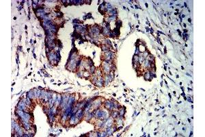Immunohistochemical analysis of paraffin-embedded rectum cancer tissues using PAX8 mouse mAb with DAB staining.