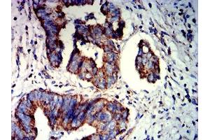 Immunohistochemical analysis of paraffin-embedded rectum cancer tissues using PAX8 mouse mAb with DAB staining. (PAX8 anticorps  (AA 60-261))