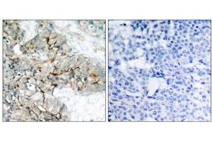 Immunohistochemical analysis of paraffin-embedded human breast carcinoma tissue using Integrin β3 (phospho-Tyr773) antibody (E011060). (Integrin beta 3 anticorps  (pTyr773))