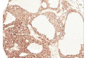 IHC-P Image Immunohistochemical analysis of paraffin-embedded Hepatocellular carcinoma Huh7 xenograft, using AGT, antibody at 1:100 dilution. (AGT anticorps)