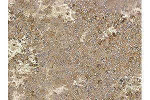 ABIN6257930 and ABIN6274821 at 1/100 staining human melanoma by IHC-P. (AGXT2L2 anticorps  (C-Term))