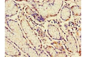 Immunohistochemistry of paraffin-embedded human gastric cancer using ABIN7160277 at dilution of 1:100