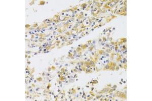 Immunohistochemistry of paraffin-embedded human gastric cancer using PA2G4 Antibody.