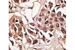 IHC analysis of FFPE human breast carcinoma tissue stained with the BMPR1A antibody (BMPR1A anticorps  (AA 21-51))