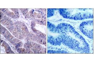 Immunohistochemical analysis of paraffin-embedded human colon carcinoma tissue using AMPK1/AMPK2 (Ab-485/491) antibody (E021130). (PRKAA1/PRKAA2 anticorps)