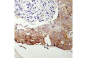 Immunohistochemical analysis of cGK 2 staining in human prostate cancer formalin fixed paraffin embedded tissue section.