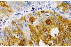 Immunohistochemistry of paraffin-embedded Human colon carcinoma using TFF1 Polyclonal Antibody at dilution of 1:200 (40x lens). (TFF1 anticorps)