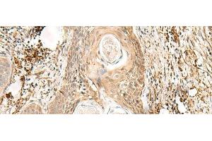 Immunohistochemistry of paraffin-embedded Human esophagus cancer tissue using ZNF397 Polyclonal Antibody at dilution of 1:80(x200) (ZNF397 anticorps)
