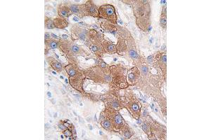Formalin-fixed and paraffin-embedded human hepatocarcinoma tissue reacted with CYP3A5 antibody (C-term), which was peroxidase-conjugated to the secondary antibody, followed by DAB staining. (CYP3A5 anticorps  (C-Term))