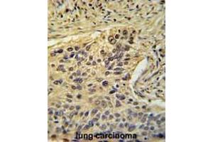 TAF2 Antibody (C-Term) immunohistochemistry analysis in formalin fixed and paraffin embedded human lung carcinoma followed by peroxidase conjugation of the secondary antibody and DAB staining. (TAF2 anticorps  (C-Term))