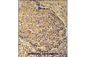 IGSF1 antibody immunohistochemistry analysis in formalin fixed and paraffin embedded human prostate carcinoma followed by peroxidase conjugation of the secondary antibody and DAB staining. (IGSF1 anticorps  (C-Term))