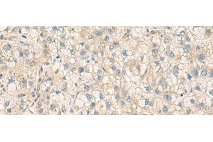 Immunohistochemistry of paraffin-embedded Human liver cancer tissue using PPM1M Polyclonal Antibody at dilution of 1:100(x200) (PPM1M anticorps)