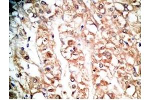 Human kidney cancer tissue was stained by rabbit Anti-BNP-45 (Mouse) Antiserum (BNP-45 anticorps  (AA 51-95))