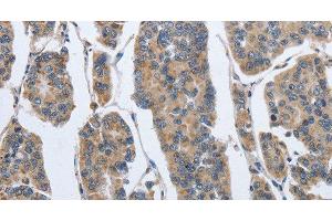 Immunohistochemistry of paraffin-embedded Human breast cancer using IPO7 Polyclonal Antibody at dilution of 1:40 (IPO7 anticorps)