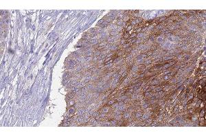 ABIN6276972 at 1/100 staining Human urothelial cancer tissue by IHC-P. (CD27 anticorps  (Internal Region))