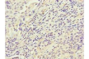 Immunohistochemistry of paraffin-embedded human lung cancer using ABIN7155154 at dilution of 1:100 (HK3 anticorps  (AA 1-270))