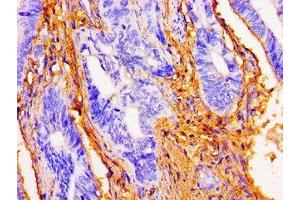 Immunohistochemistry of paraffin-embedded human colon cancer using ABIN7149775 at dilution of 1:100 (Desmoglein 1 anticorps  (AA 384-539))
